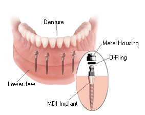 MDI Denture Stabilization System - Full Denture Implants